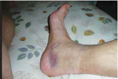 الجرح الداخلي الجرح الداخلي